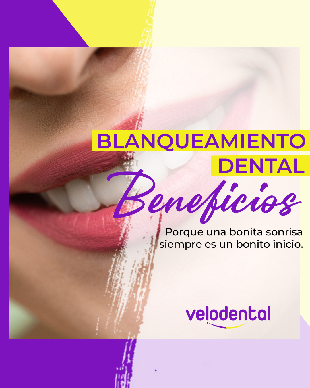blanqueamiento dental carabanchel, dentistas carabanchel para blanqueamiento dental, blanquear dientes carabanchel blanqueamiento dental carabanchel, dentistas carabanchel para blanqueamiento dental, blanquear dientes carabanchel
